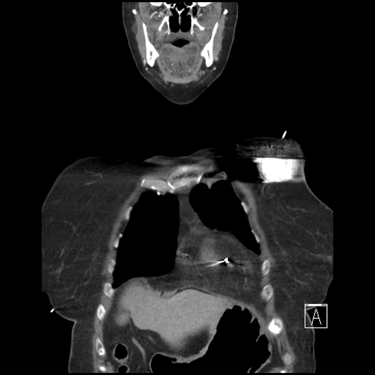 File:Aortic intramural hematoma with dissection and intramural blood pool (Radiopaedia 77373-89491 C 7).jpg