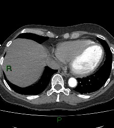 Aortic valve endocarditis (Radiopaedia 87209-103485 C 72).jpg