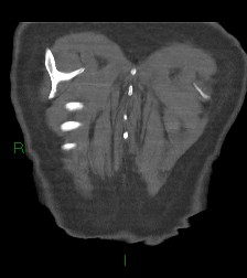 File:Aortic valve endocarditis (Radiopaedia 87209-103485 D 4).jpg
