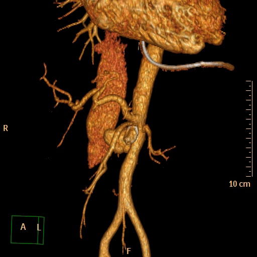 File:Aorto-left renal vein fistula (Radiopaedia 45534-49628 D 3).jpg