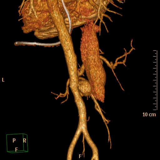 File:Aorto-left renal vein fistula (Radiopaedia 45534-49628 D 33).jpg