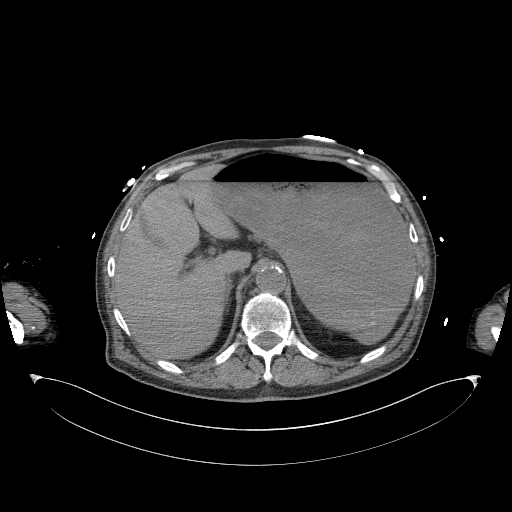 Aortoduodenal fistula (Radiopaedia 75286-86415 Axial non-contrast 12).jpg