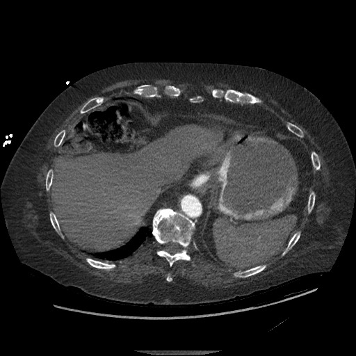 File:Aortoesophageal fistula with endovascular repair (Radiopaedia 73781-84592 Axial C+ CTPA 147).jpg