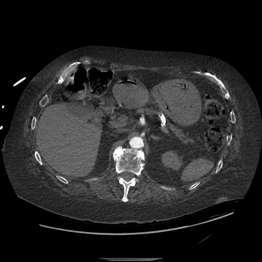 Aortoesophageal fistula with endovascular repair (Radiopaedia 73781-84592 Axial C+ CTPA 192).jpg
