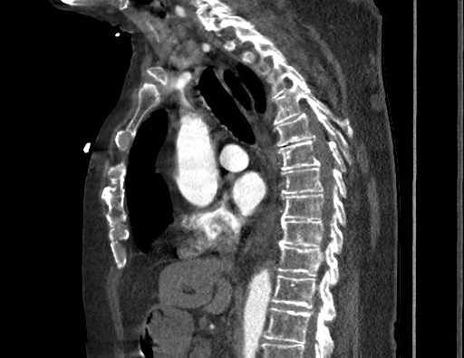 File:Aortoesophageal fistula with endovascular repair (Radiopaedia 73781-84592 Sagittal C+ CTPA 94).jpg