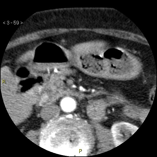 File:Aortoiliac occlusive disease (Radiopaedia 16828-16548 A 59).jpg