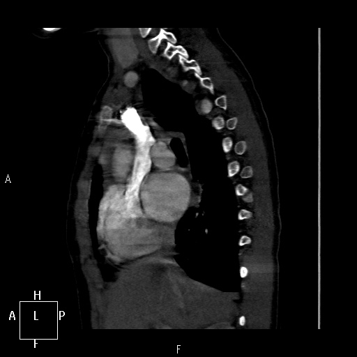 File:Aortopulmonary septal defect (Radiopaedia 41990-45013 Sagittal C+ CTPA 36).jpg
