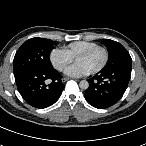 Apical lung mass mimic - neurogenic tumor (Radiopaedia 59918-67521 A 51).jpg