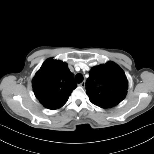 File:Apical pleural calcification (Radiopaedia 46141-50499 Axial C+ delayed 16).png