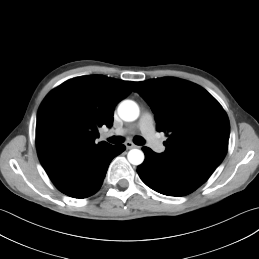 File:Apical pleural calcification (Radiopaedia 46141-50499 Axial C+ delayed 28).png