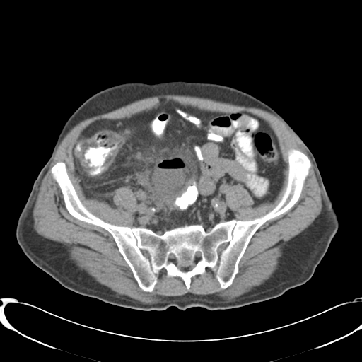 File:Appendiceal abscesses (Radiopaedia 50999-56542 Axial non-contrast 60).png