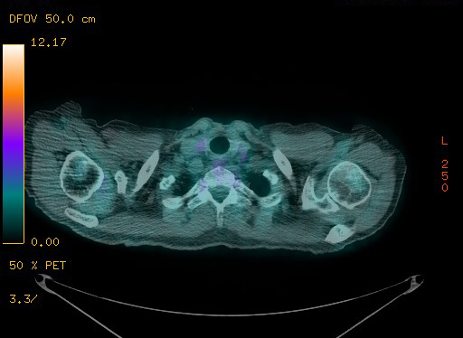 Appendiceal adenocarcinoma complicated by retroperitoneal abscess (Radiopaedia 58007-65041 Axial PET-CT 30).jpg