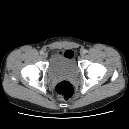 File:Appendicitis complicated by post-operative collection (Radiopaedia 35595-37114 A 82).jpg