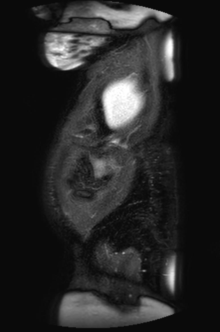 Appendicitis in gravida (MRI) (Radiopaedia 89433-106395 Sagittal T2 SPAIR 4).jpg