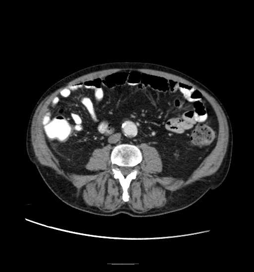Appendicitis with localized perforation and abscess formation (Radiopaedia 49035-54130 A 52).jpg