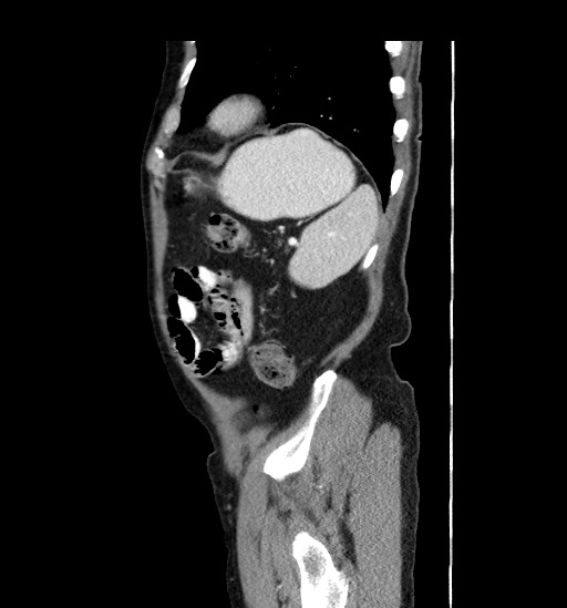 File:Appendicitis with localized perforation and abscess formation (Radiopaedia 49035-54130 C 54).jpg