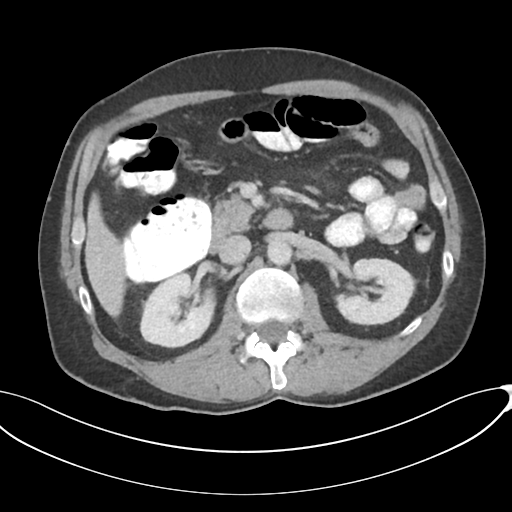 Appendicitis with thickening of the terminal ileum (Radiopaedia 42432-45550 A 39).png