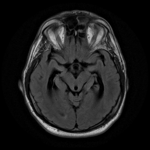 File:Aqueduct stenosis with corpus callosum hypoattenuation post shunting (Radiopaedia 37212-38969 Axial FLAIR 9).png