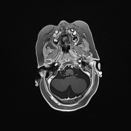 Aqueductal stenosis (Radiopaedia 73974-84802 Axial T1 C+ 44).jpg
