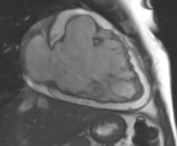 File:Arrhythmogenic right ventricular cardiomyopathy (Radiopaedia 69431-79307 2ch cine 80).jpg