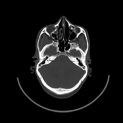 File:Arrow injury to the brain (Radiopaedia 72101-82607 Axial bone window 58).jpg