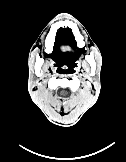 Arrow injury to the brain (Radiopaedia 72101-82607 Axial non-contrast 42).jpg
