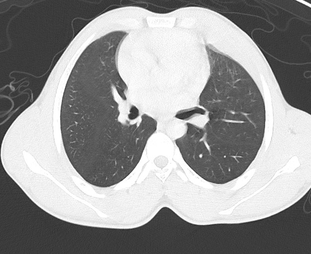 File:Arrow injury to the chest (Radiopaedia 75223-86321 Axial lung window 36).jpg