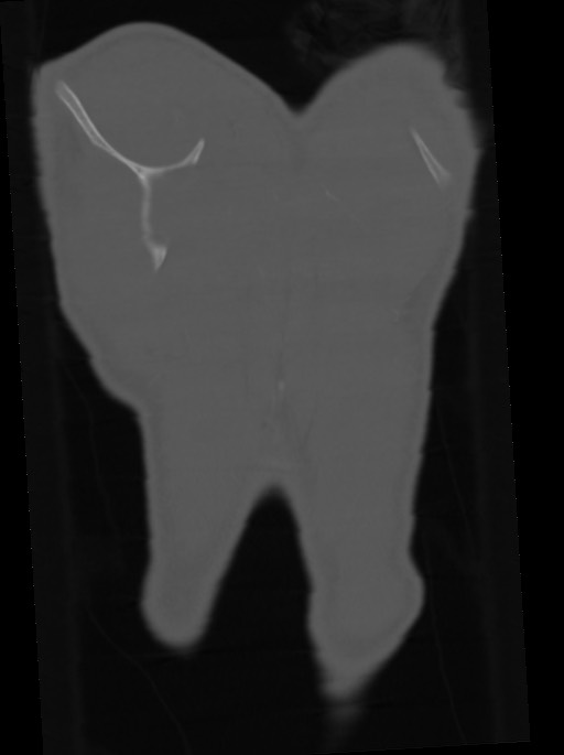Arrow injury to the neck (Radiopaedia 75225-86323 Coronal bone window 113).jpg
