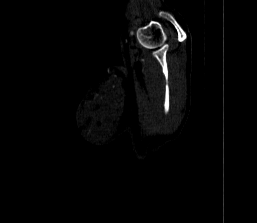 Arteria lusoria (Radiopaedia 88528-105192 C 11).jpg