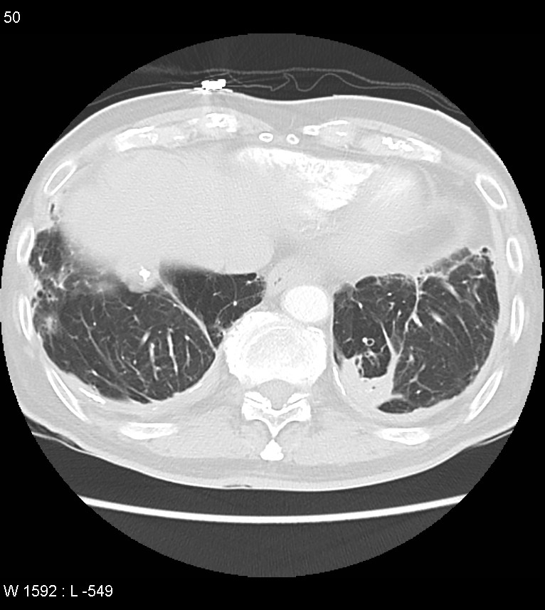 Asbestos related lung and pleural disease (Radiopaedia 14377-14301 A 47).jpg