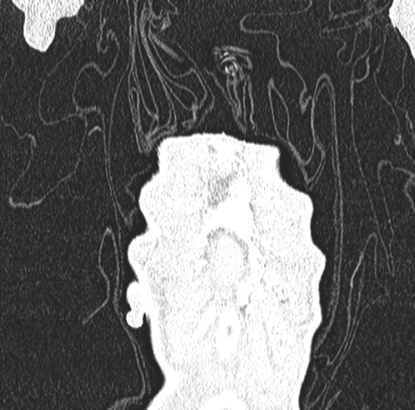 File:Aspergilloma- with Monod sign (Radiopaedia 44737-48532 Coronal lung window 110).jpg