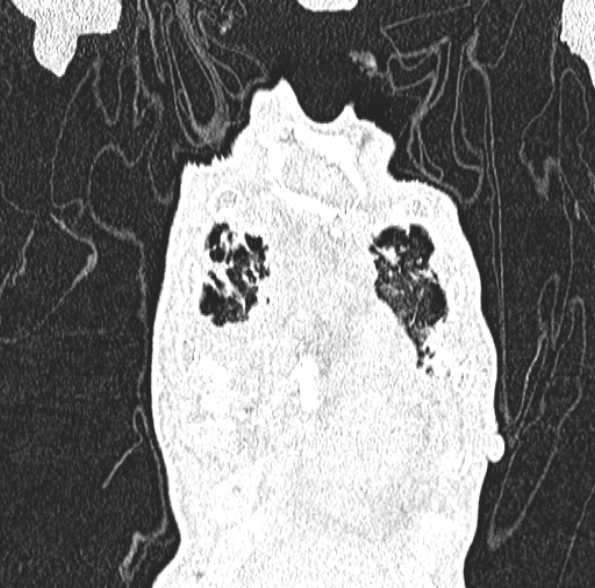 Aspergilloma- with Monod sign (Radiopaedia 44737-48532 Coronal lung window 130).jpg