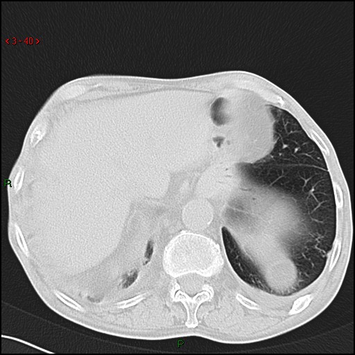 File:Aspergilloma (Radiopaedia 14842-14787 Axial lung window 40).jpg