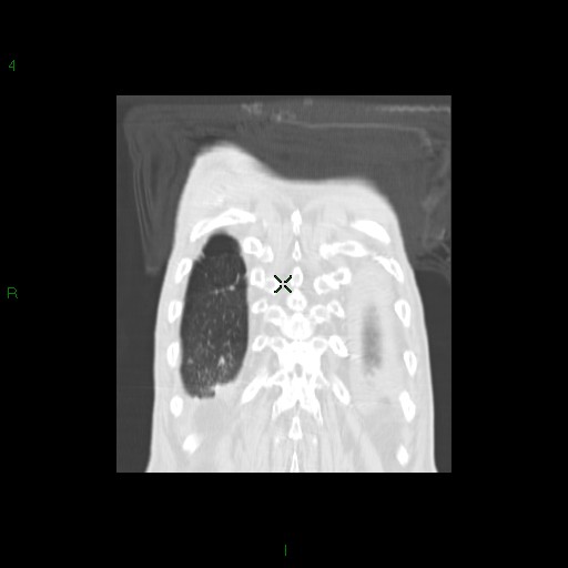 File:Aspergilloma (Radiopaedia 14842-14787 Coronal lung window 34).jpg