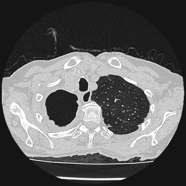 Aspergilloma (Radiopaedia 24458-24763 Axial lung window 10).jpg