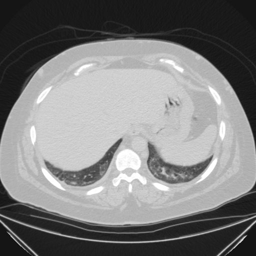 Aspergilloma (Radiopaedia 39611-41932 Axial lung window 121).jpg