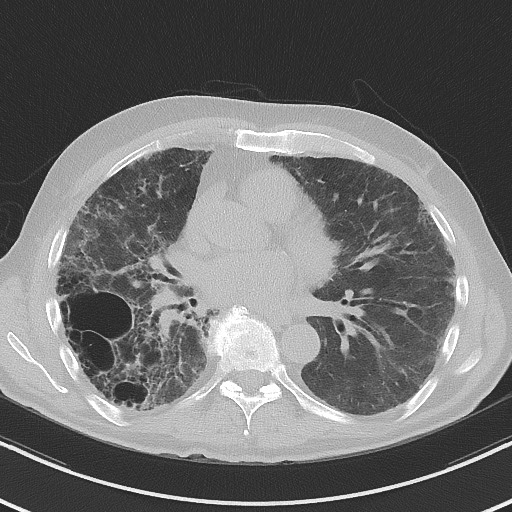Aspergilloma on background pulmonary fibrosis (Radiopaedia 60942-68757 A 32).jpg
