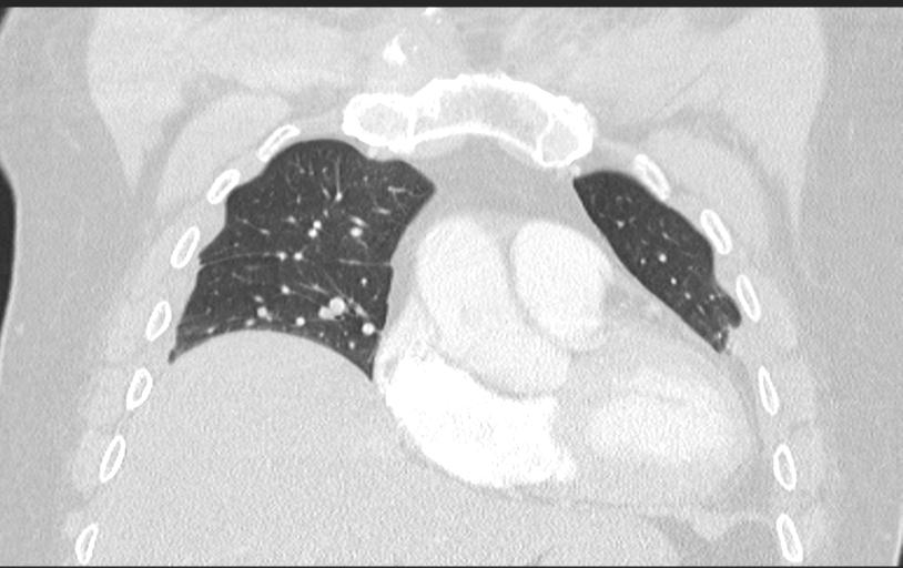 Aspirated tooth (Radiopaedia 28584-28844 Axial lung window 42).jpg