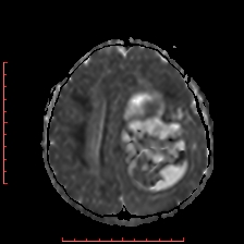 Astroblastoma (Radiopaedia 74287-85162 Axial ADC 45).jpg
