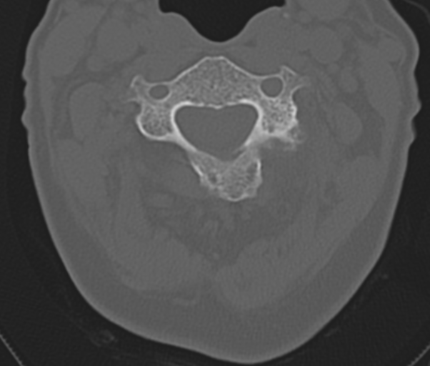 Atlanto-axial subluxation (Radiopaedia 36610-38176 Axial bone window 24).png
