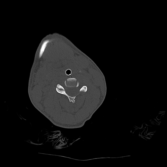 Atlanto-occipital dissociation (Traynelis type 1), C2 teardrop fracture, C6-7 facet joint dislocation (Radiopaedia 87655-104061 Axial bone window 45).jpg