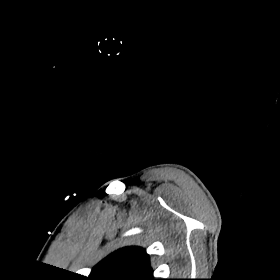 Atlanto-occipital dissociation (Traynelis type 1), C2 teardrop fracture, C6-7 facet joint dislocation (Radiopaedia 87655-104061 D 93).jpg
