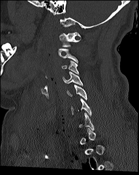 Atlanto-occipital dissociation - Traynelis type 1 (Radiopaedia 87570-103948 Sagittal bone window 57).jpg