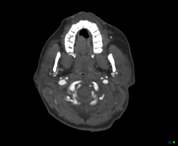File:Atlanto-occipital dissociation - Traynelis type 1 (Radiopaedia 87570-103949 A 53).jpg