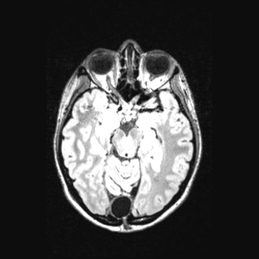 Atretic encephalocoele with inferior vermis hypoplasia (Radiopaedia 30443-31108 Axial 64).jpg