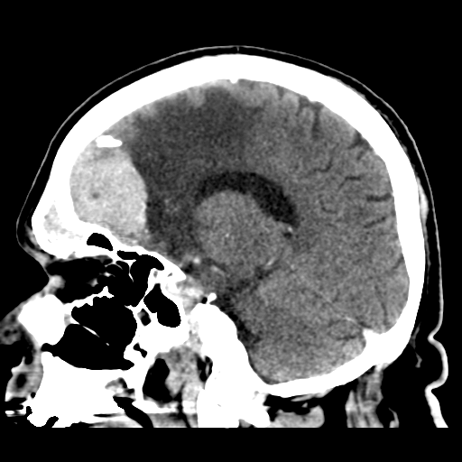 Atypical meningioma (WHO grade II) with brain invasion (Radiopaedia 57767-64728 Sagittal C+ 21).png