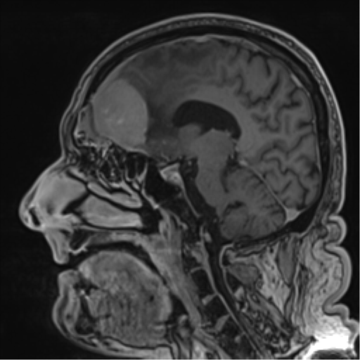 Atypical meningioma (WHO grade II) with brain invasion (Radiopaedia 57767-64729 Sagittal T1 C+ 39).png