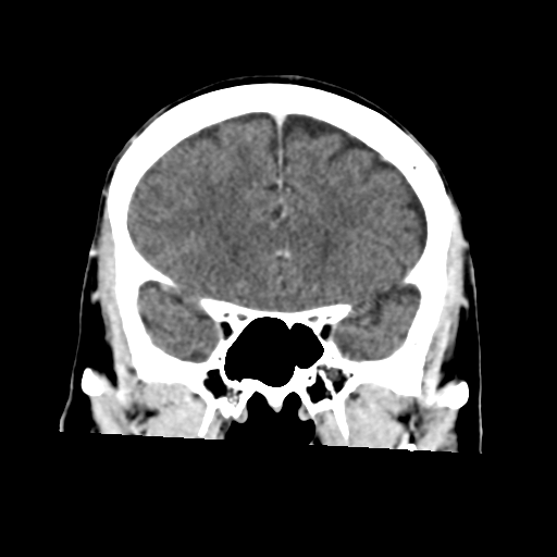 Atypical meningioma with skull invasion (Radiopaedia 34357-35649 Coronal C+ delayed 21).png