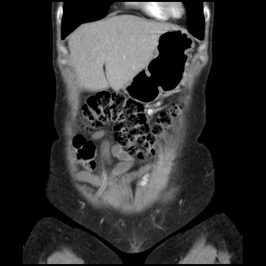 File:Atypical renal cyst (Radiopaedia 17536-17251 C 32).jpg