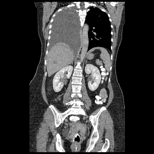 File:Atypical retroperitoneal lymphocoeles with large leiomyoma of uterus (Radiopaedia 32084-33024 B 15).jpg